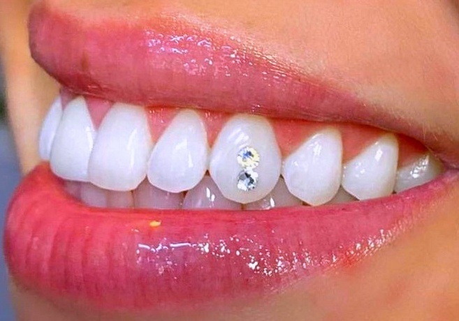 Dental Jewellery 